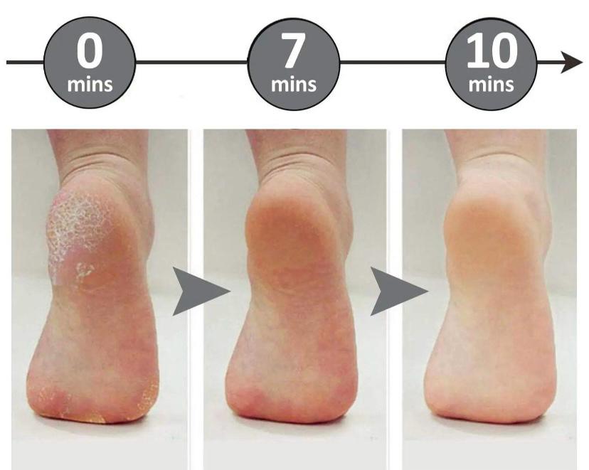 Electric Foot File Callus Remover