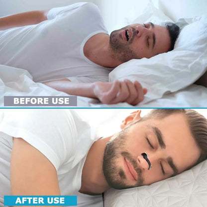 Sleepco Anti-Snore Nasal Dilator – Easy Breathing Kit